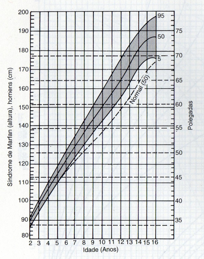 CURVA DE CRESCIMENTO ESTATURAL - SÍNDROME DE MARFAN - MASCULINO